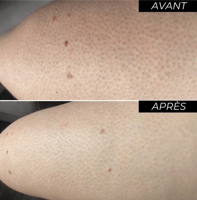 Cuisse : avant et après le protocole laser