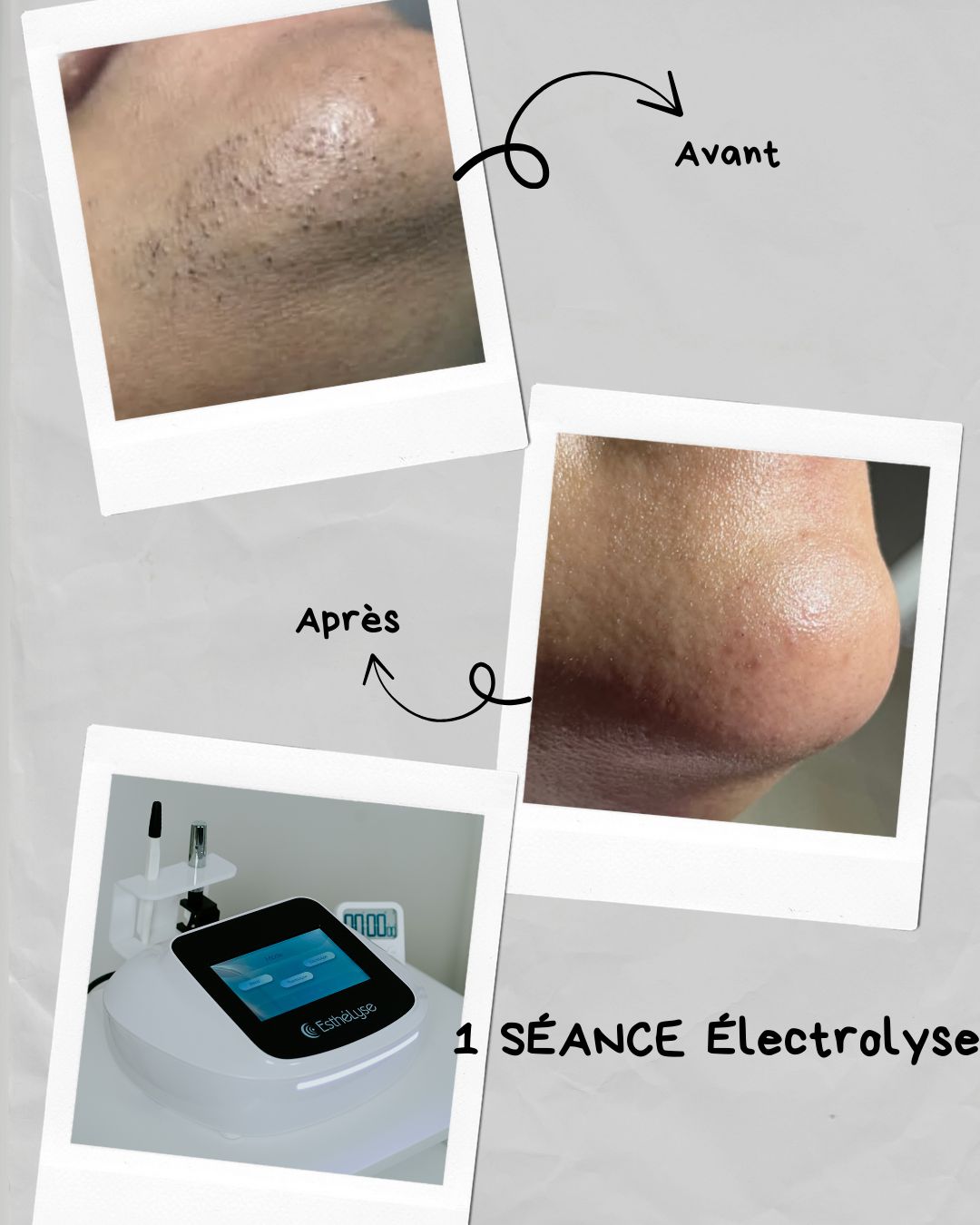 Électrolyse : avant et après une séance
